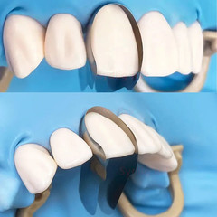 30x Dental Anterior Matrix Bands Proximal Anterior Strips Twin Anterior Matrices
