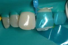 Dental Blue Strip M8 Contoured Anterior Matrix Restoration Matrices 0.05mm