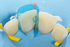 Dental Blue Strip M8 Contoured Anterior Matrix Restoration Matrices 0.05mm
