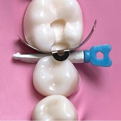 Dental Matrix Bands Ring Sectional Matrice Clamp Wedges Fit Palodent V3 System