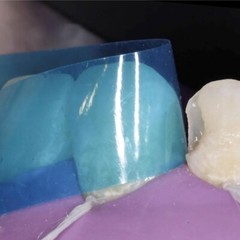 Dental Polyester Matrix Bands Proximal Anterior Matrices System Blue Strips 50pc