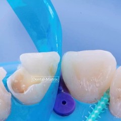 Dental Contoured Anterior Matrix Bands Teeth Restoration Blue Strip Matrice USA