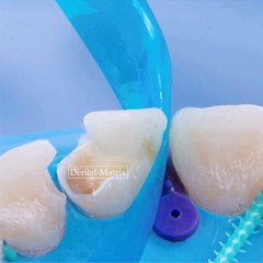 30/50p Dental Contoured Anterior Matrix Bands Restoration Strip Twin Matrices M8