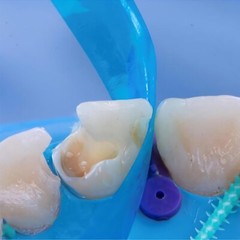 Dental Blue Strip Anterior Matrix Strips IV Composite Matrices Bands