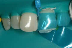 Dental Blue Strip Anterior Matrix Strips IV Composite Matrices Bands